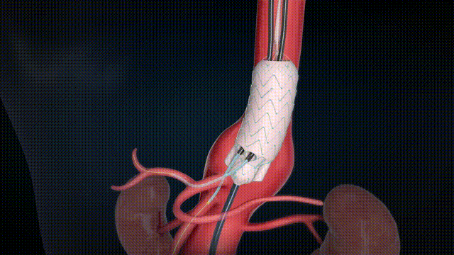 G-Branch 分支重建+髂内释放（深色无字幕20s）2024.10.11 00_00_00-00_00_30.gif